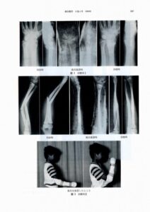 前腕骨骨折の装具療法